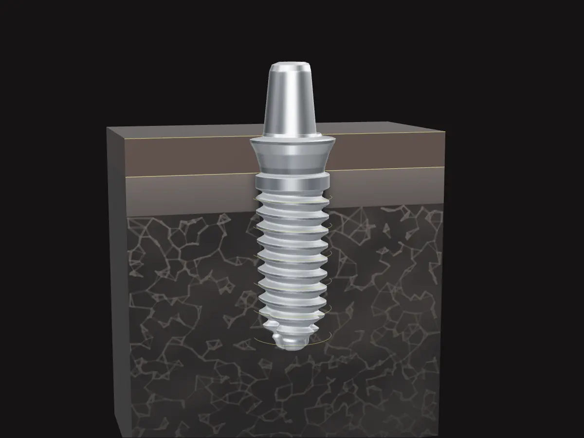 Kemik kesitine yerleştirilmiş implantın çizimi